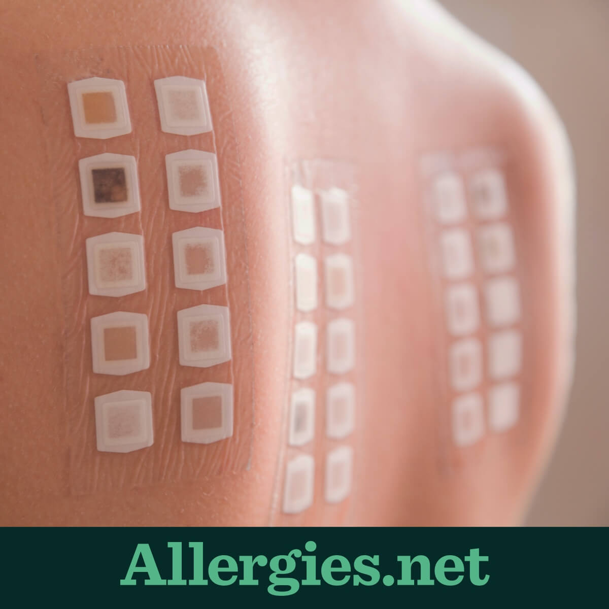 With a patch test, a tiny amount of allergen is placed on the skin, then covered. The patch is left on for 2 days. Allergic reactions may develop between 2 and 7 days.