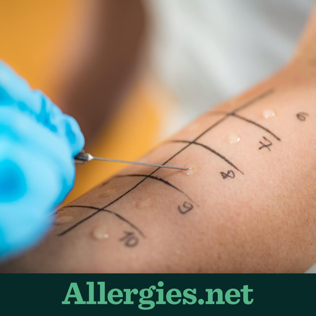 For a skin prick test a small amount of a possible allergen is dropped on the skin. A needle is then used to gently prick the site. There is no bleeding. The site is checked after 15 minutes for signs of an allergic reaction. Reactions include itching, and a raised, red bump. 