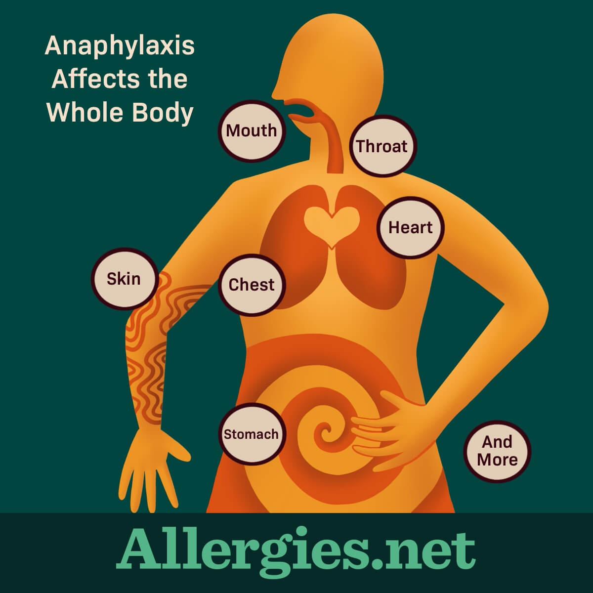 Anaphylaxis is a severe, life-threatening allergic reaction that affects multiple body systems at the same time.